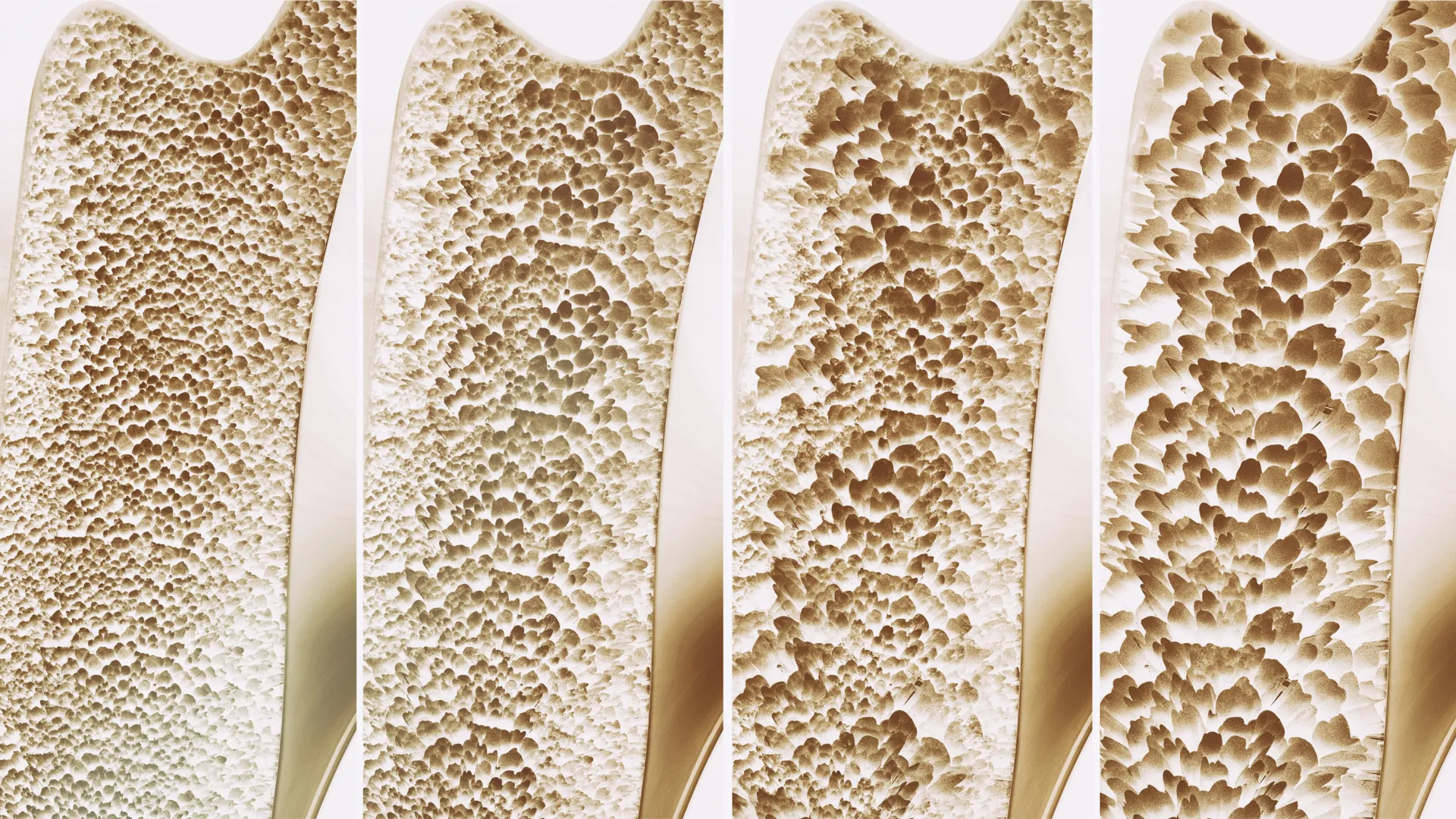 Landmark BMJ Review: Calcium & Vitamin D Ineffective for Fracture Prevention in Most Older Adults