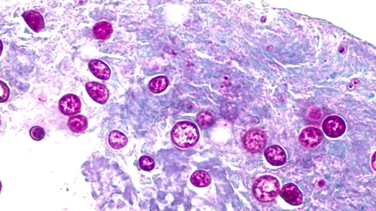 CDC Probes Systemic Food Supply Failures Amid Multi-State Cyclospora Outbreak