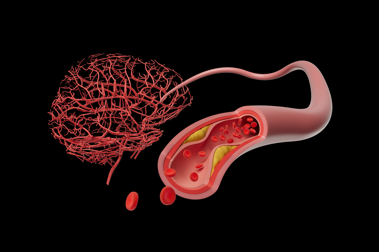 Avoiding 3 Midlife Vascular Risks Extends Dementia-Free Life by 13+ Years